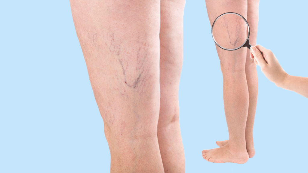 How to get rid of spider veins