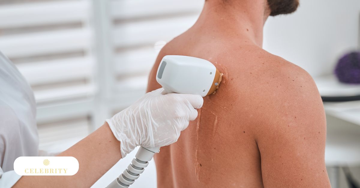 A man with a hairy chest and bare skin, illustrating the effects and risks of laser hair removal, including post-treatment redness