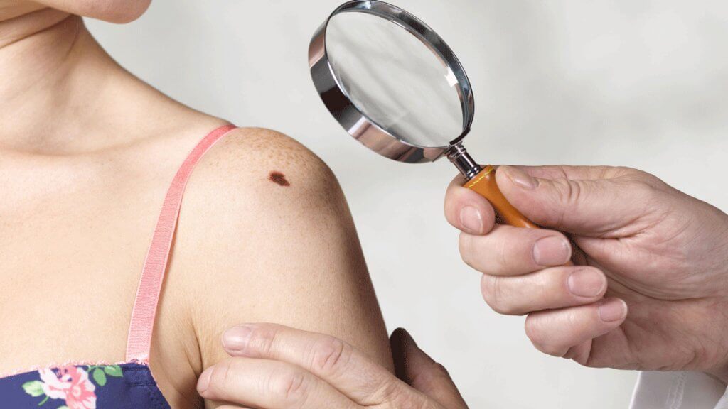 When to get checked skin moles