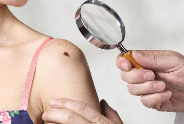 When to get checked skin moles