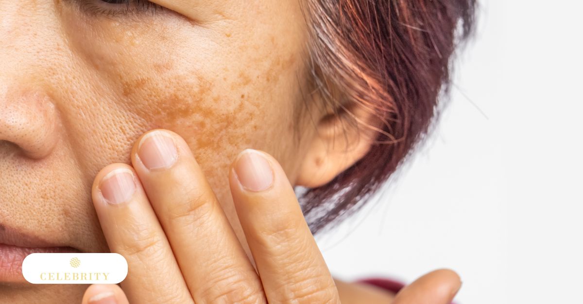 Woman receiving PRP facial treatment for reduced pigmentation and skin rejuvenation
