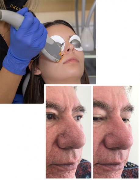 Vein removal Vein removal