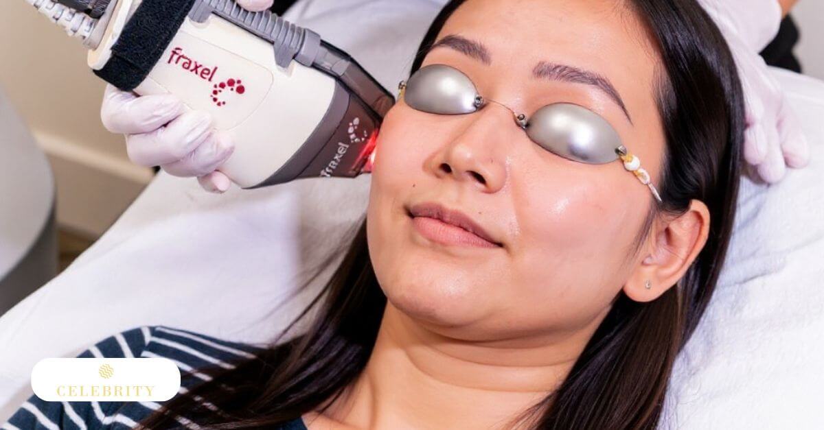 Fraxel Laser Treatment