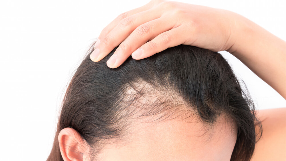 A woman needs PRP for hair restoration