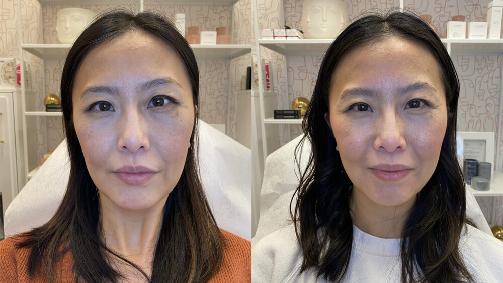 morpheus8 treatment and results