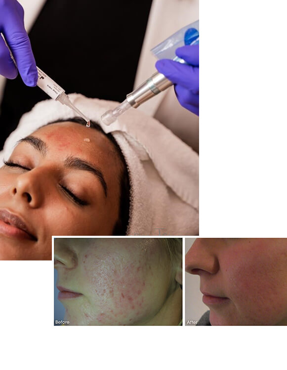 miconeedling b& a