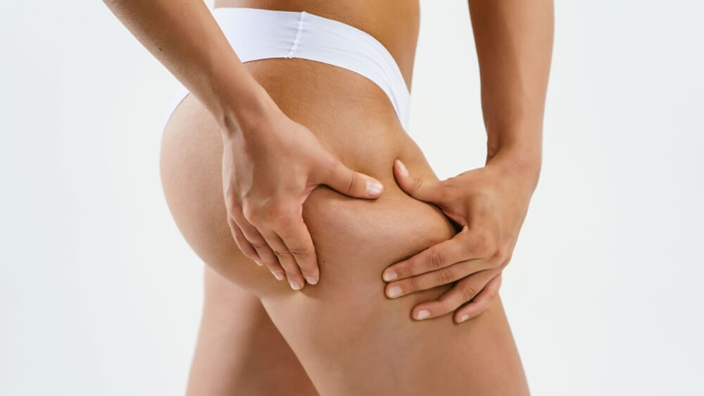 Problem of women body concept cellulite weight loss