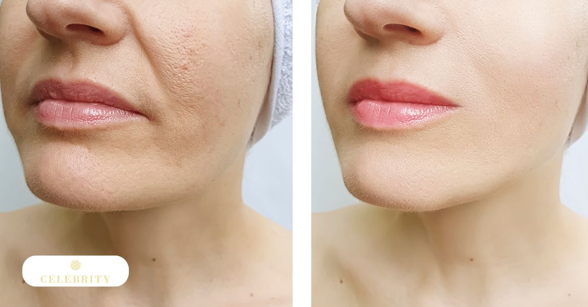 Before and after photos of a woman's face showing results of laser skin resurfacing and microdermabrasion