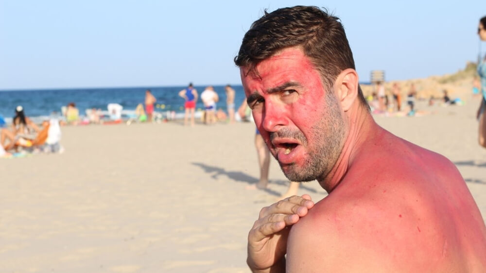 Man with lost of redness after sun tanning