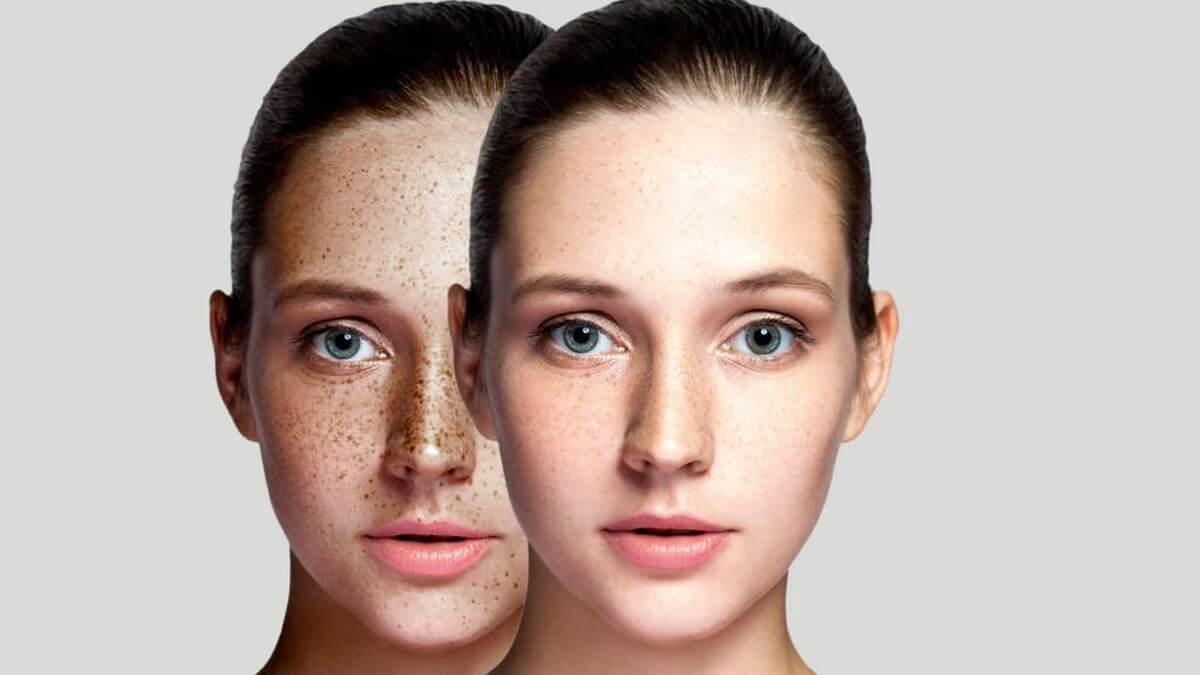 What Is The Best Treatment To Get Rid Of Freckles And Brown Spots Celebrity Laser Skin Care