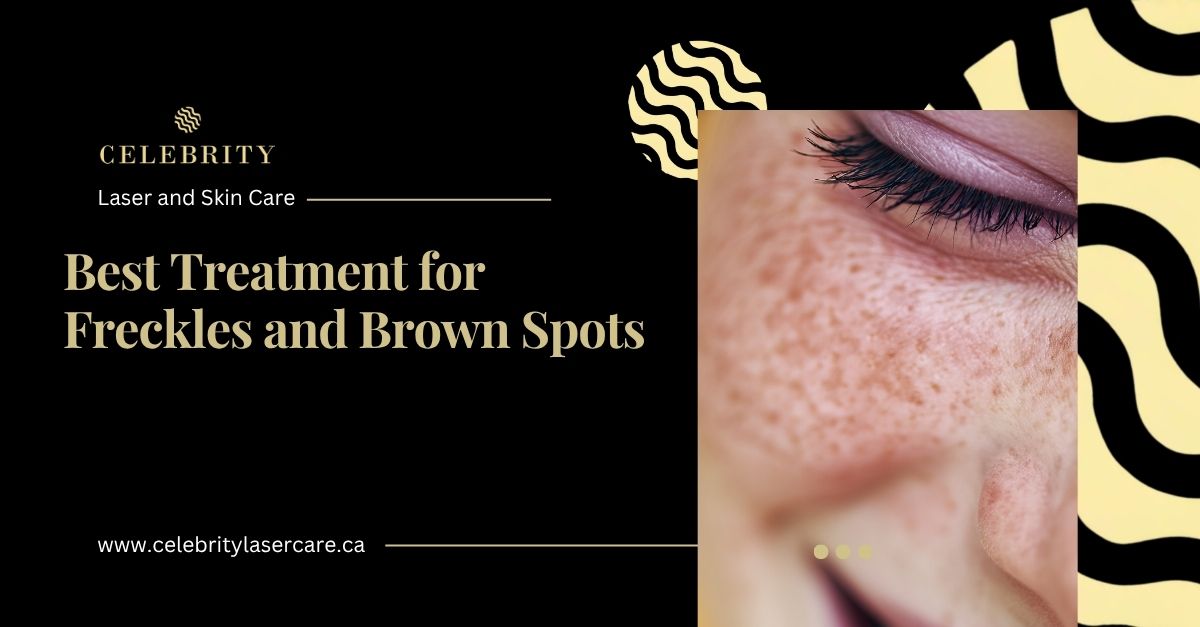 A banner discussing the best freckles and brown spots treatments by Celebrity Laser and Skin Care. On the right, a detailed photo shows visible sun spots and freckles on a person's face.