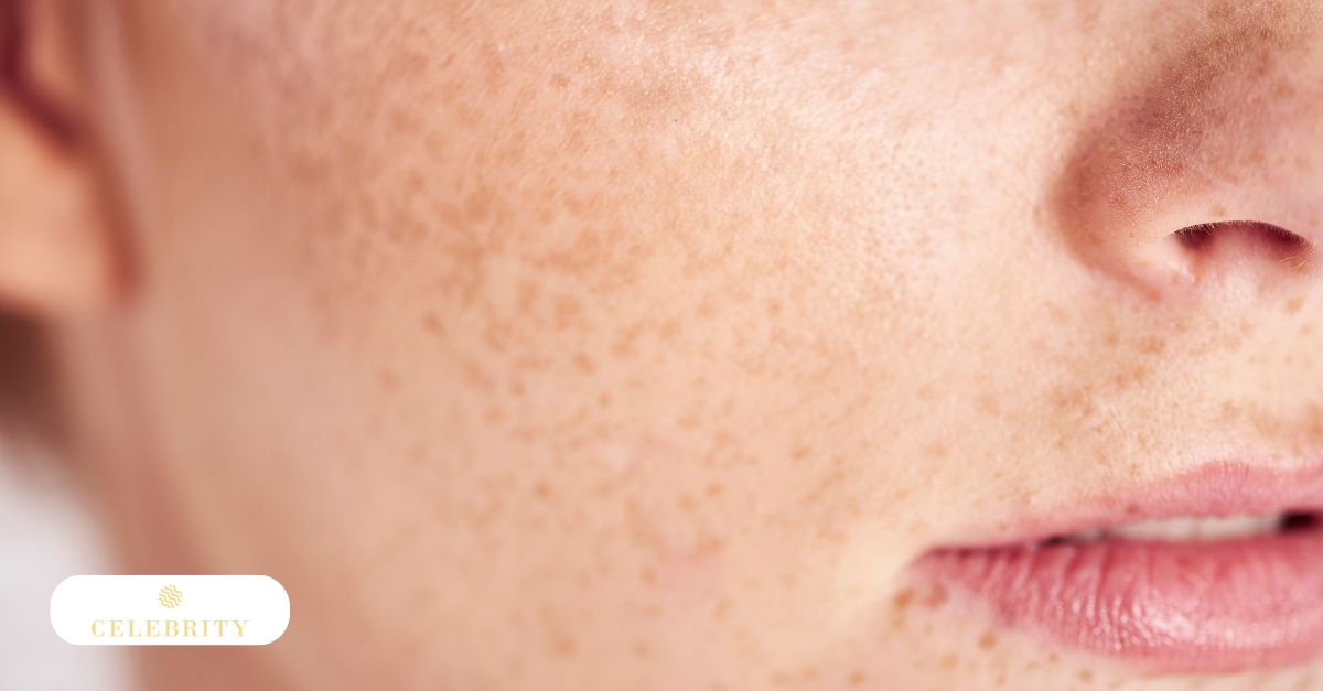 Close-up of skin pigmentation highlighting the need for medical and professional treatments for freckles and brown spots treatments.