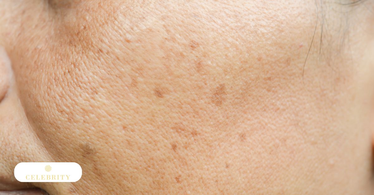 Detailed view of a person's cheek with uneven skin tone and brown spots, used to identify the best treatment for freckles.