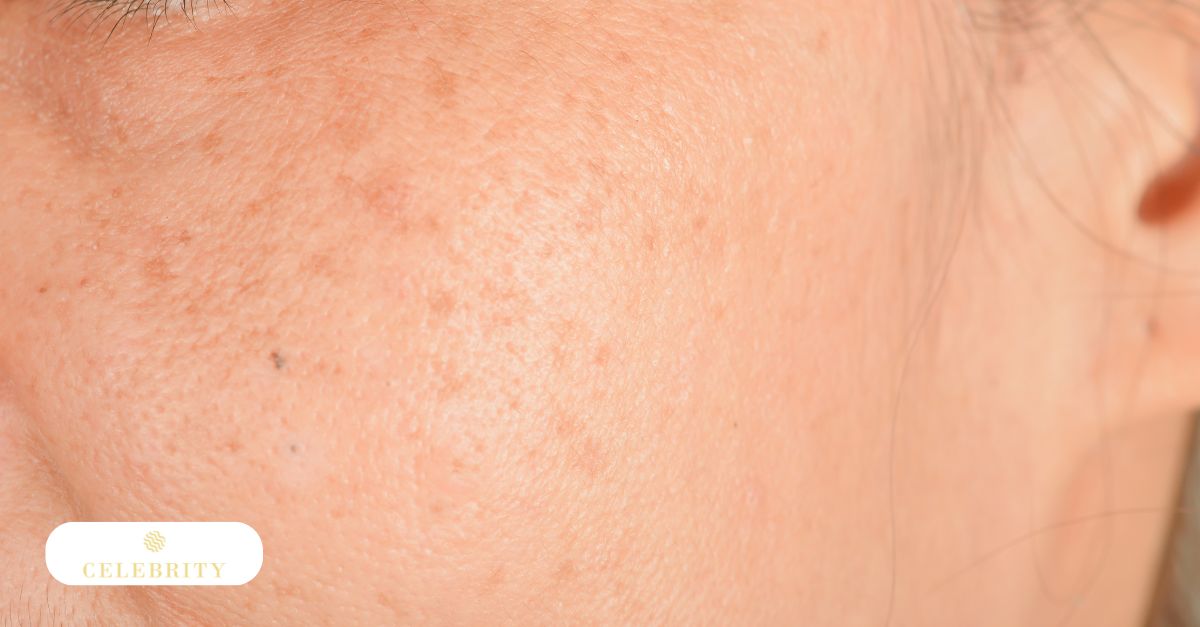 Detailed view of a person's cheek with visible brown spots, providing a visual context for why do freckles and brown spots appear.
