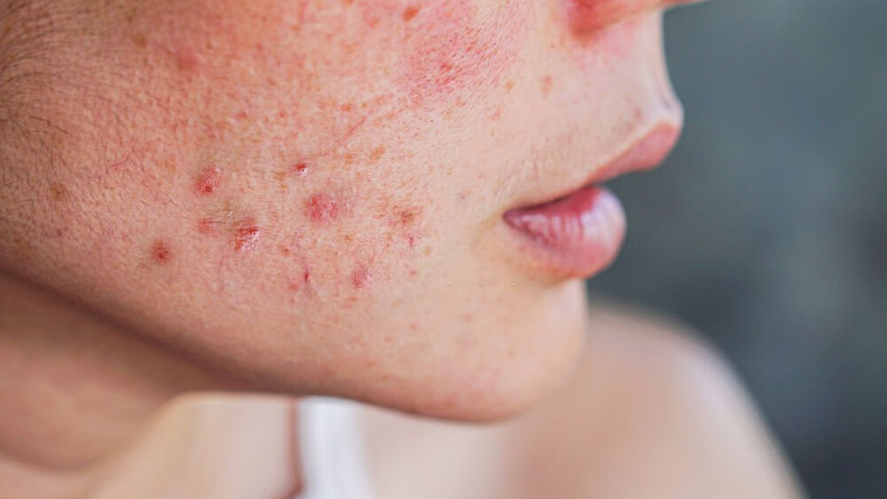 Acne on woman's face with rash skin scar and spot