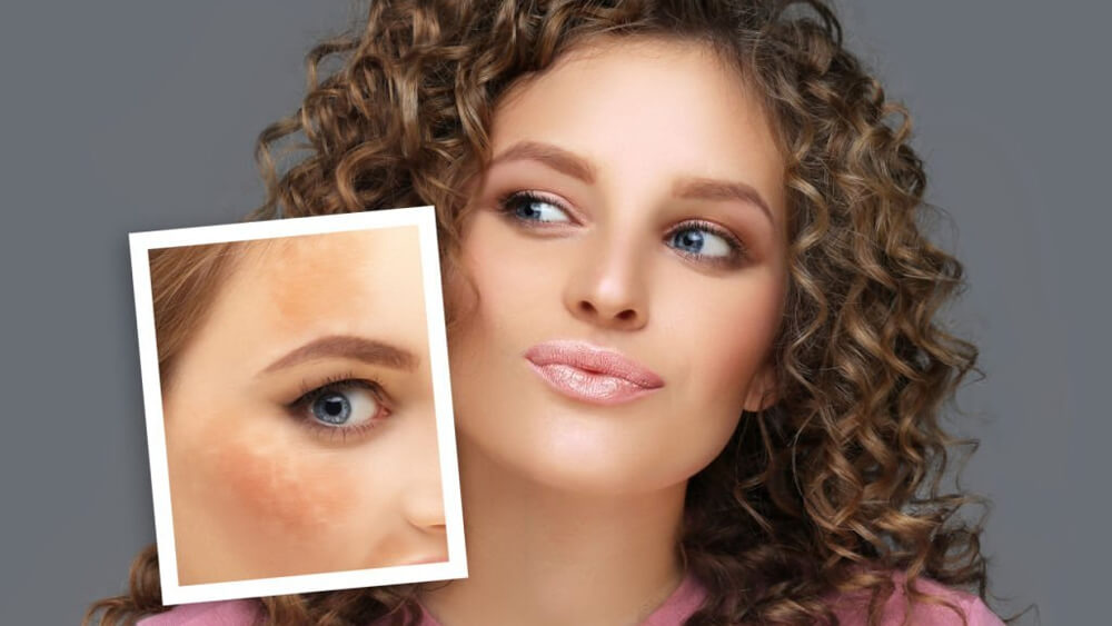 Dark spots freckles hyperpigmentation on a woman face