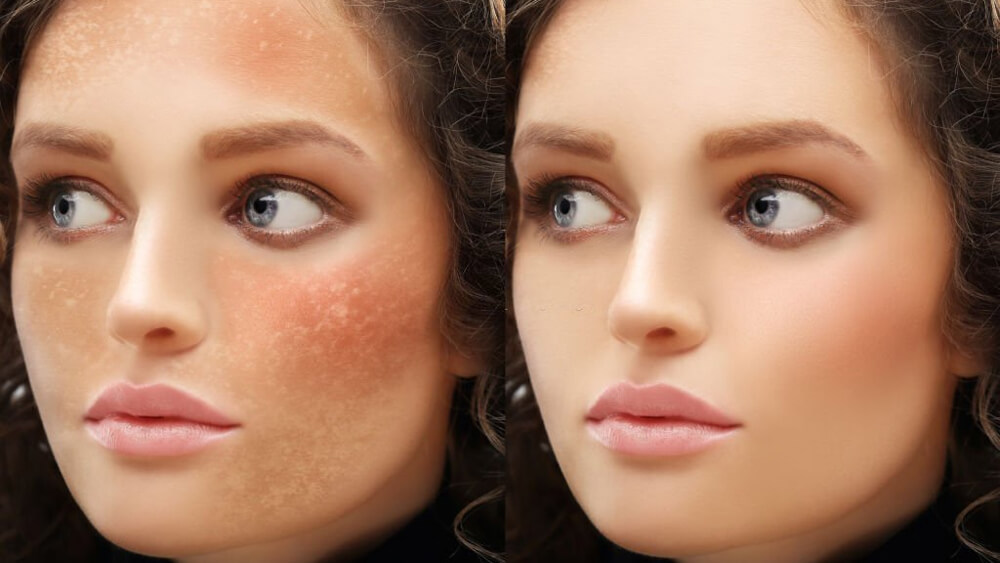 Dark spots freckles hyperpigmentation before and after treatment