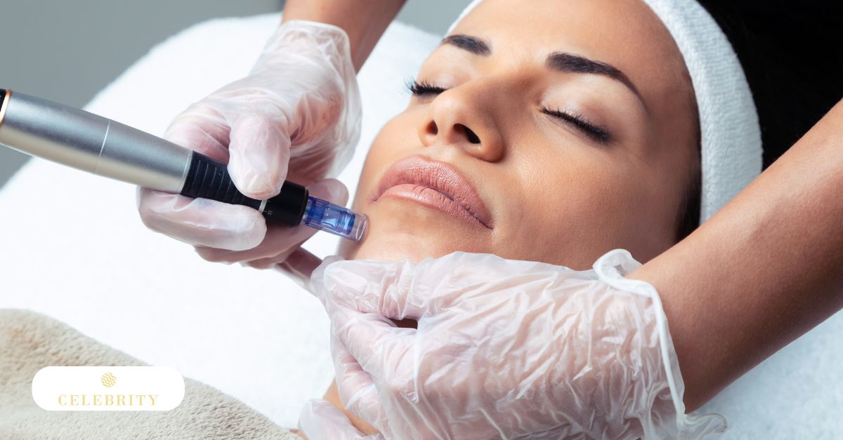 A woman receiving microneedling treatment after Botox injection