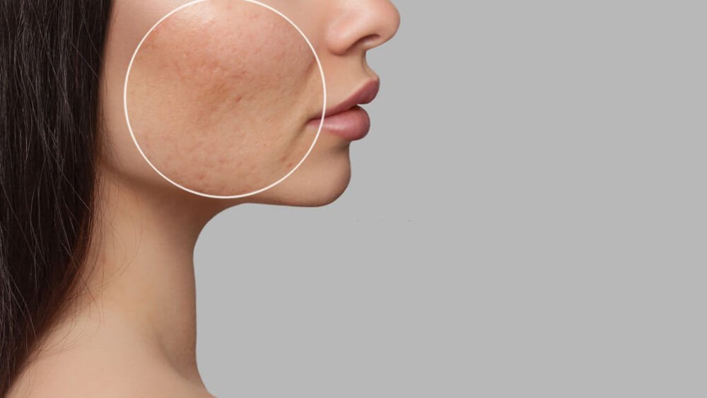 Face skin scars can be treated by microneedling