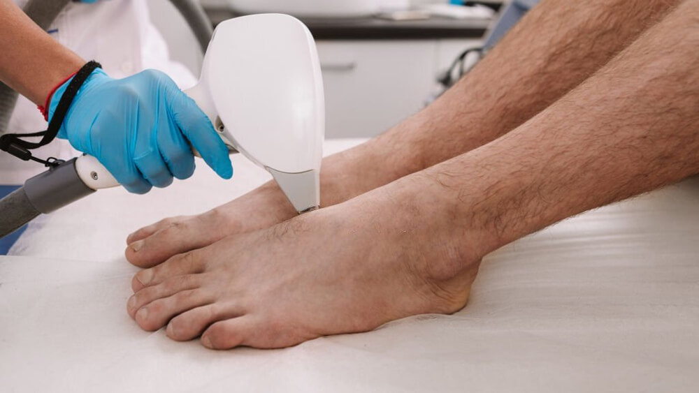 Man getting IPL body hair removal procedure in feet