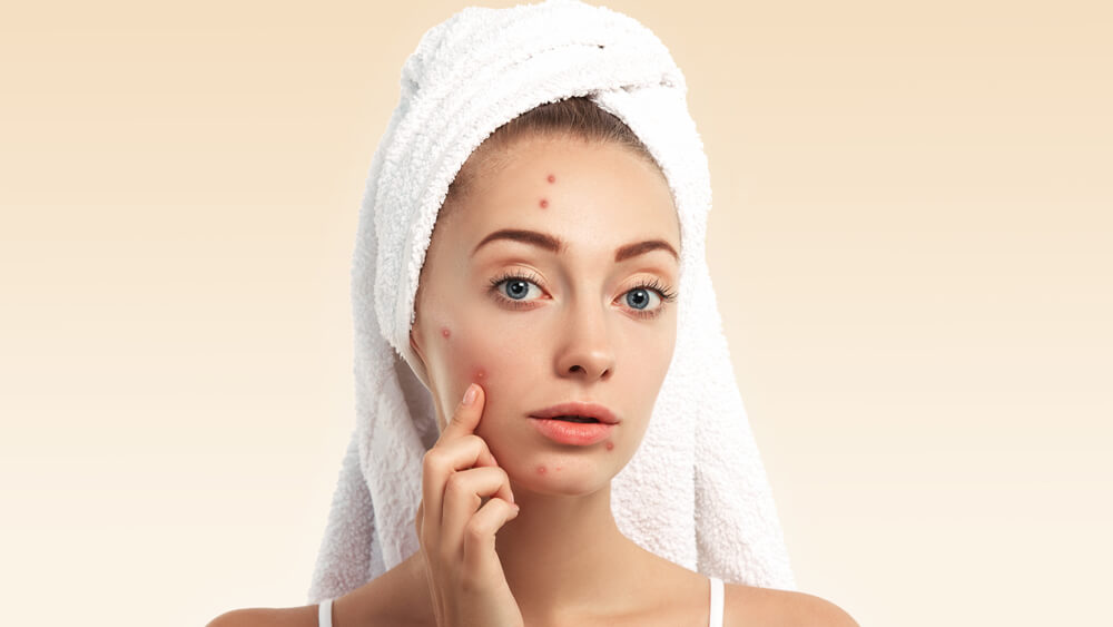 Young woman with towel on the head and pimples on her face