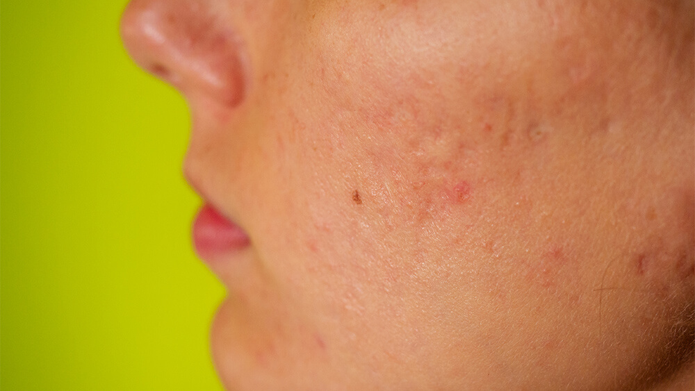 Acne scars and red festering pimples