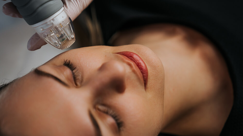 Microneedle RF lifting procedure getting done on a woman's face