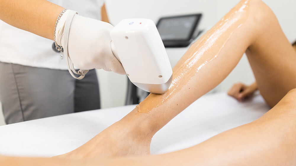 Laser hair removal process for a woman legs