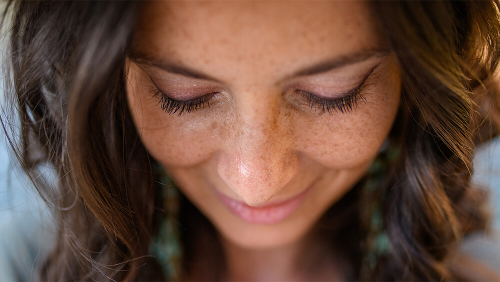A woman with melasma on her skin