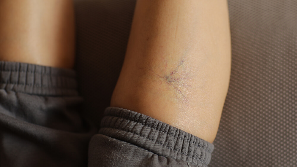 Painful varicose and spider veins on a woman's leg
