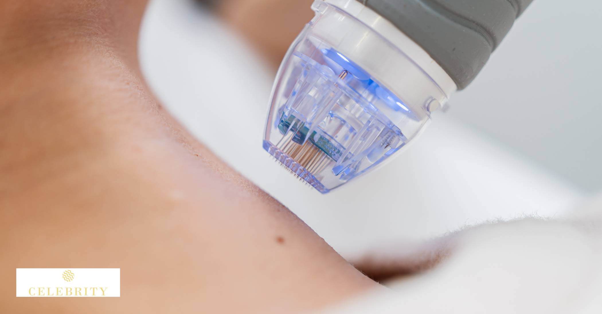 How to Maximize Microneedling Results