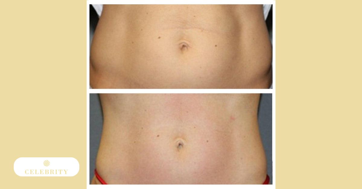 Before and after BodyFX results at Celebrity Laser & Skin Care