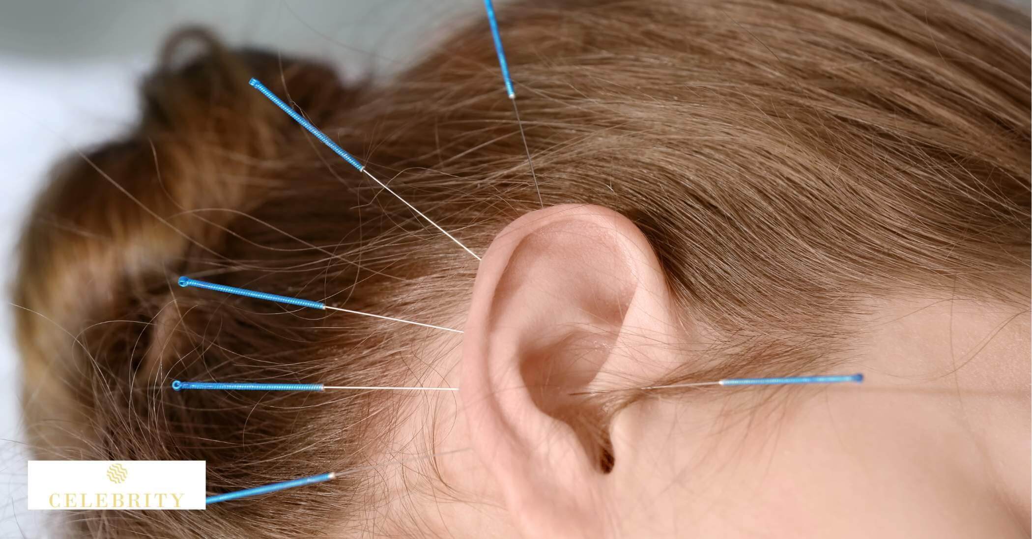 A man receiving auricular acupuncture, featuring needles placed in his ear for holistic healing.