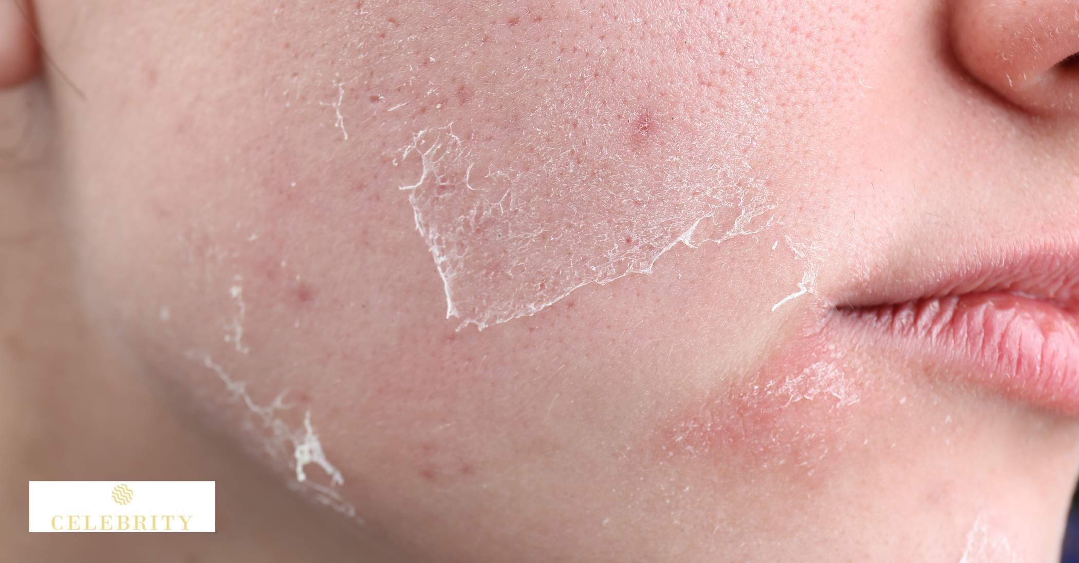 Close-up of a woman showing dryness or irritation, highlighting potential side effects of skin cycling.