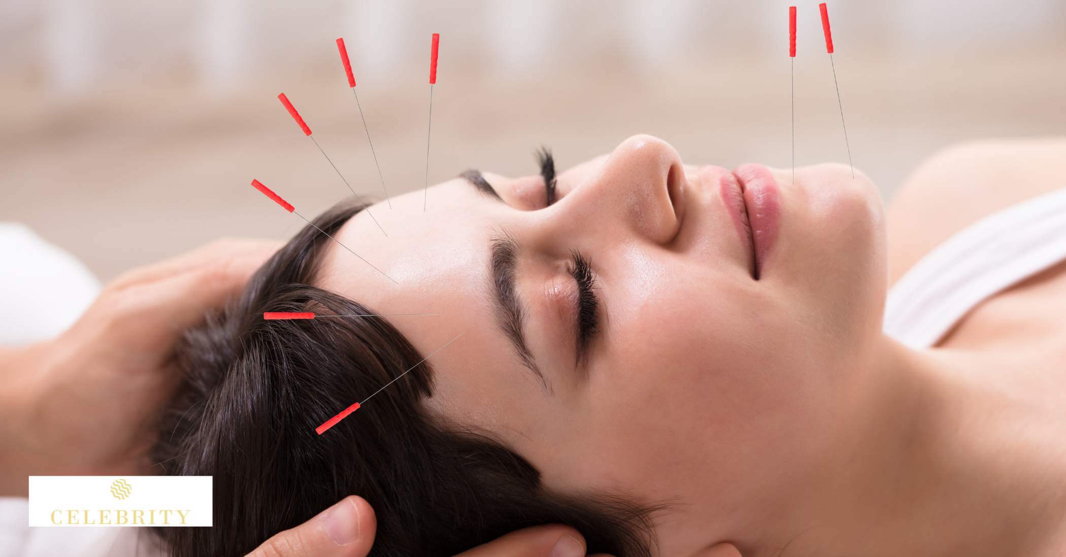 Side effects of cosmetic acupuncture