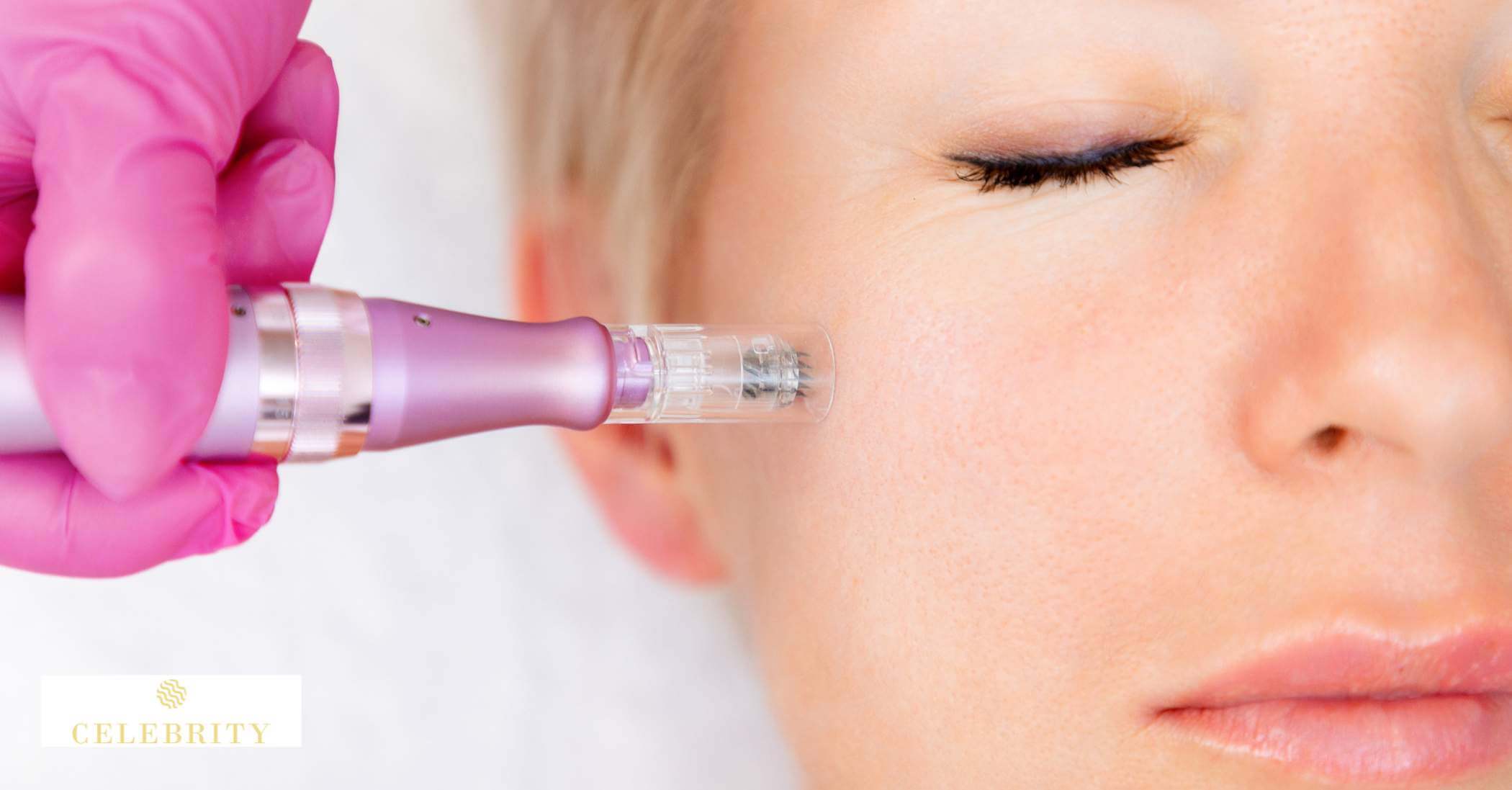 Radiofrequency Microneedling