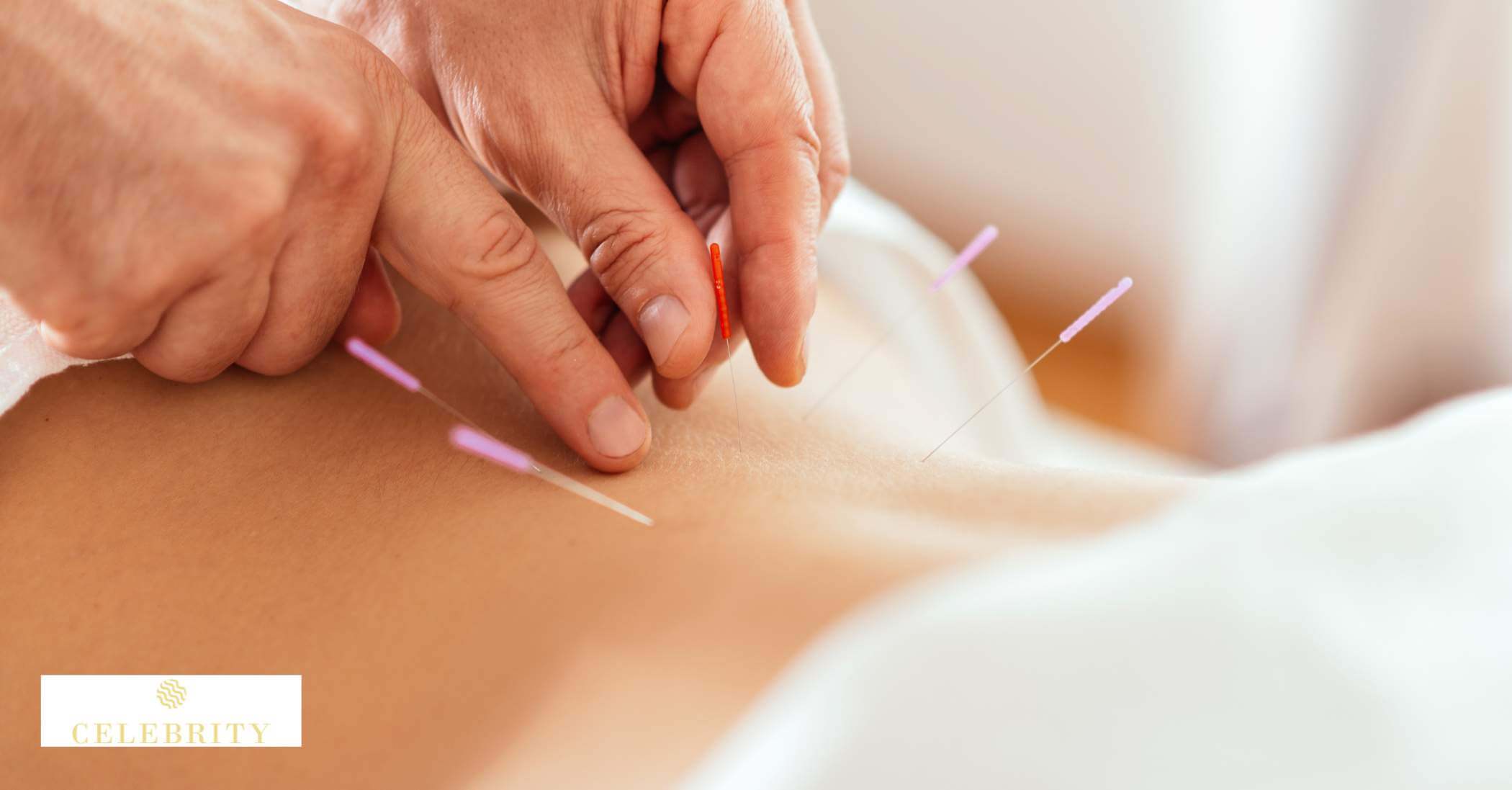 An acupuncture treatment session