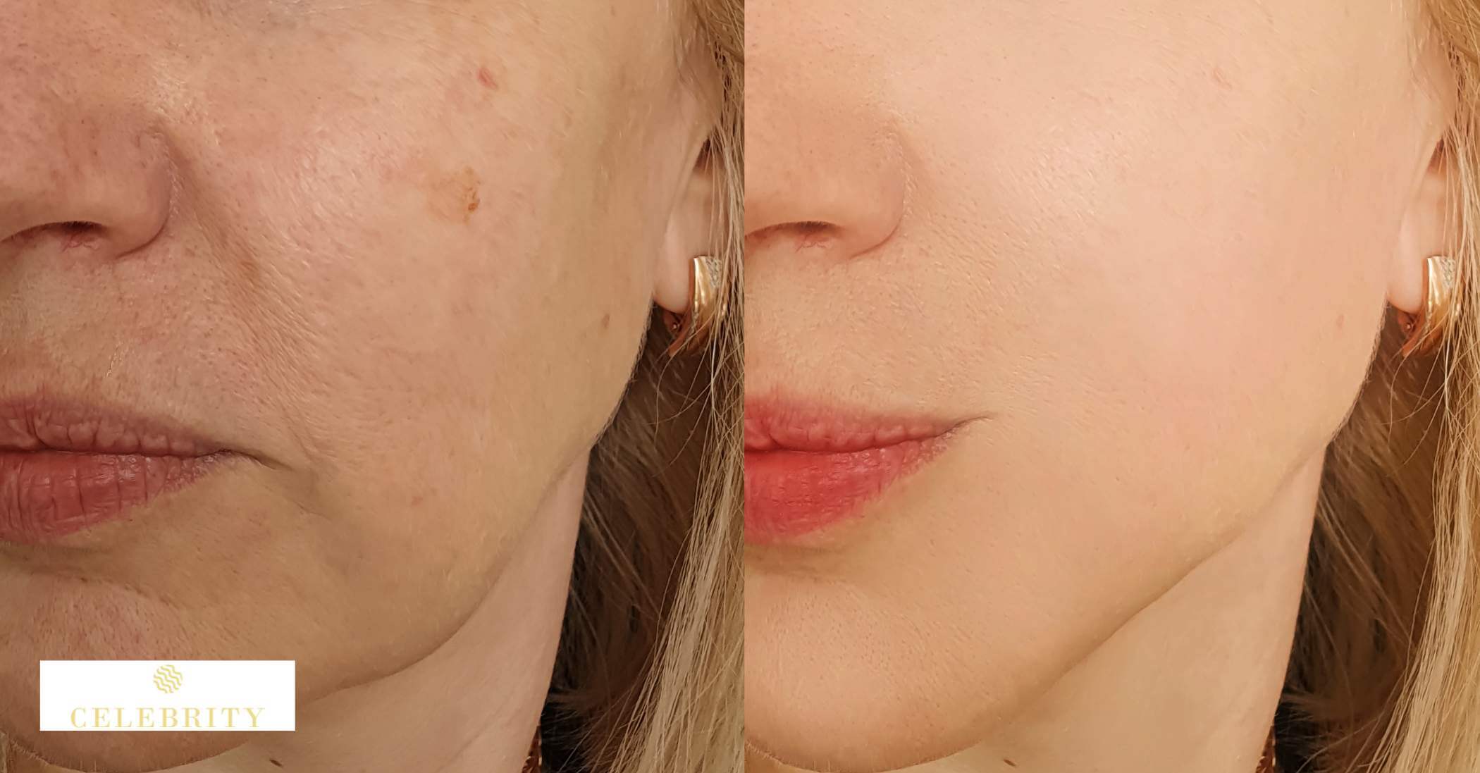 A before and after image of a patient demonstrating the use of artificial intelligence in laser treatments