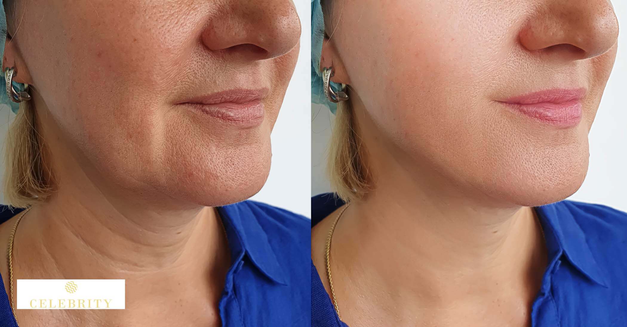 A woman’s skin before and after RF skin tightening treatment, illustrating benefits of RF skin tightening.