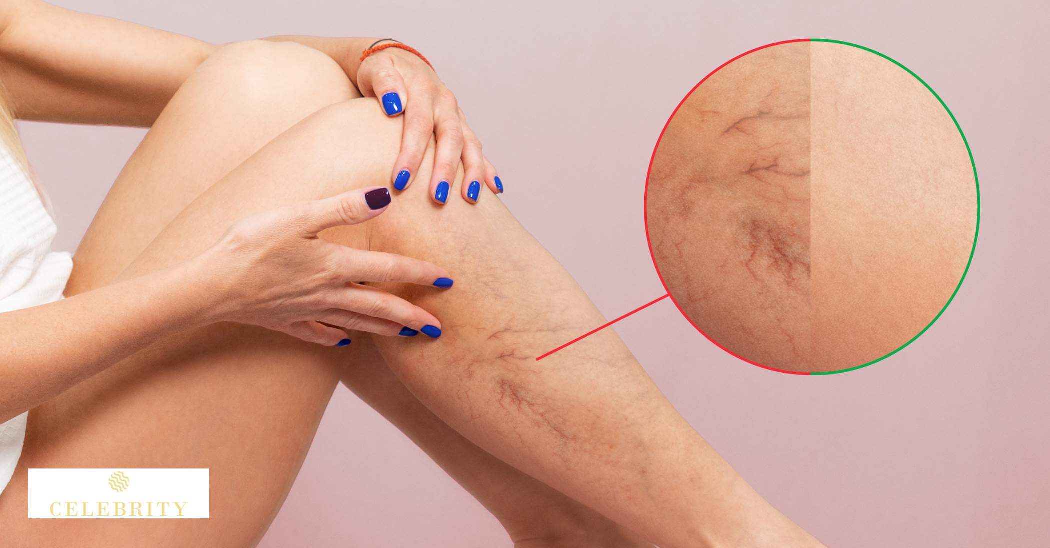 Before and after images showcasing a woman's legs, highlighting the effects of laser therapy on spider veins