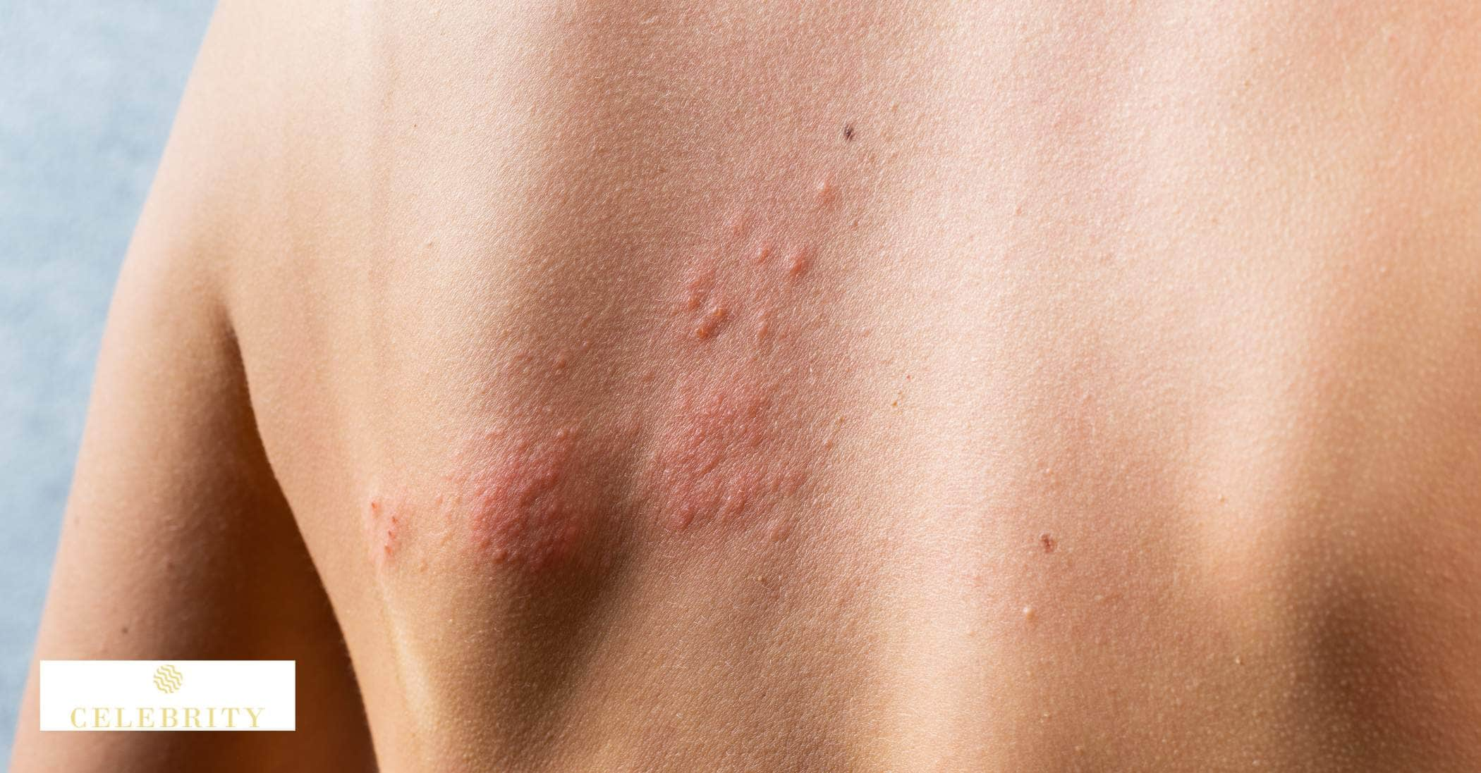 A person displaying a rash on their back, highlighting potential side effects of laser hair removal treatments