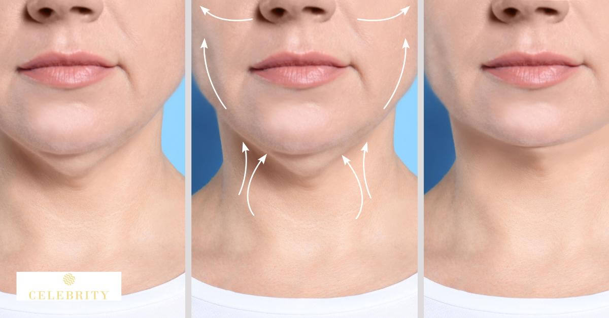 Before and after images showcasing enhanced chin and jawline with fillers.