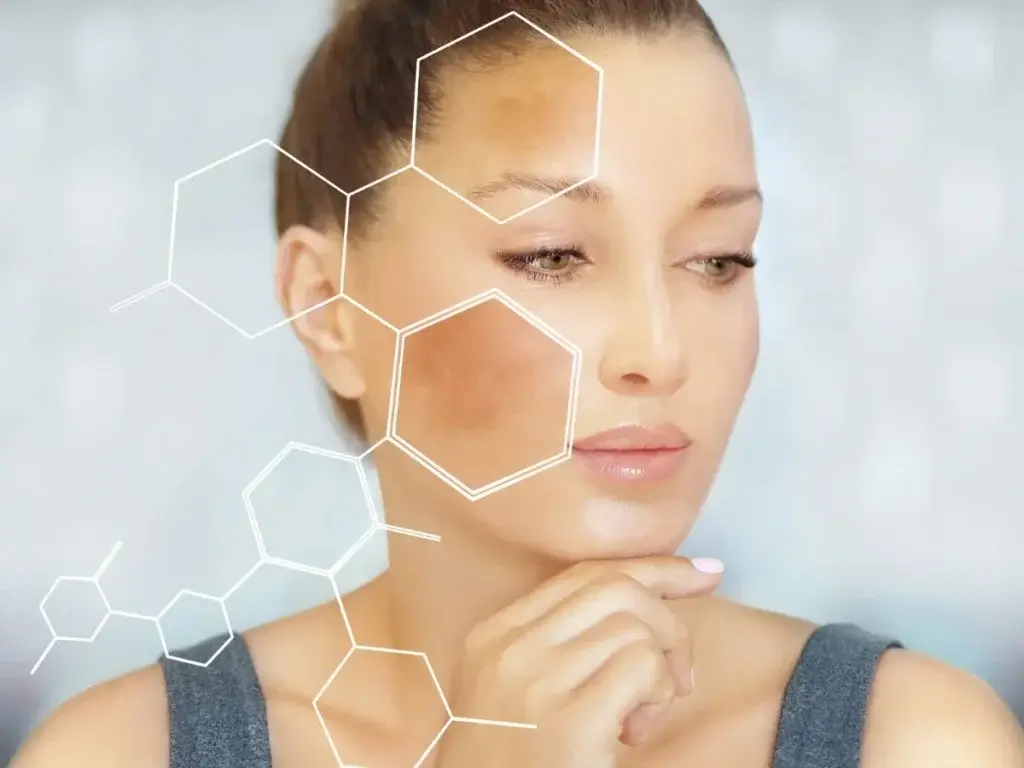 How to Identify & Treat Acne Scars