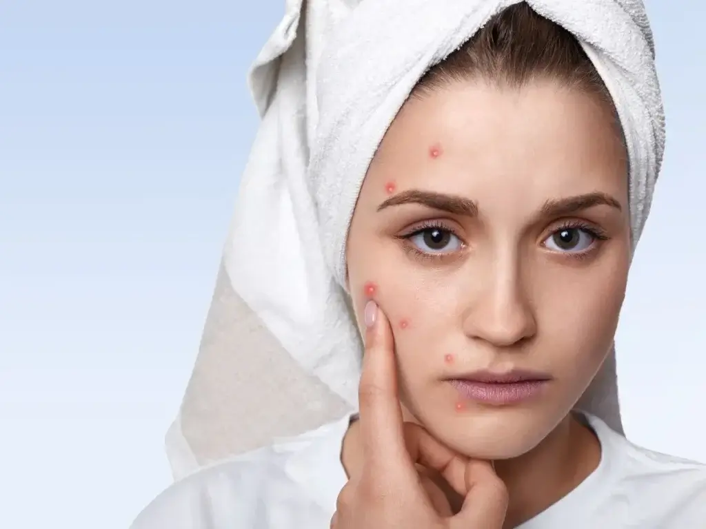 Types of Acne & When to Seek Treatment