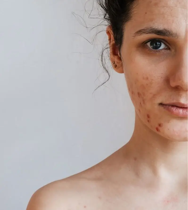 What are acne scars & how do they form?