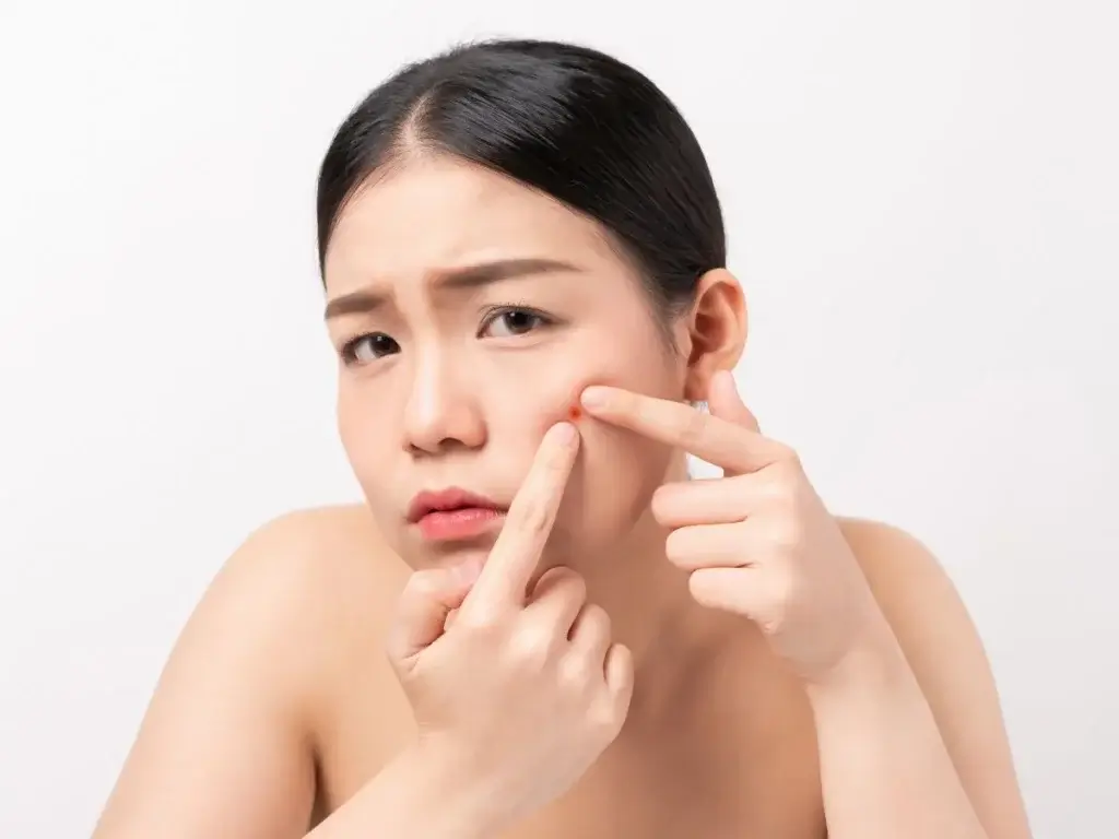 What causes acne scars?