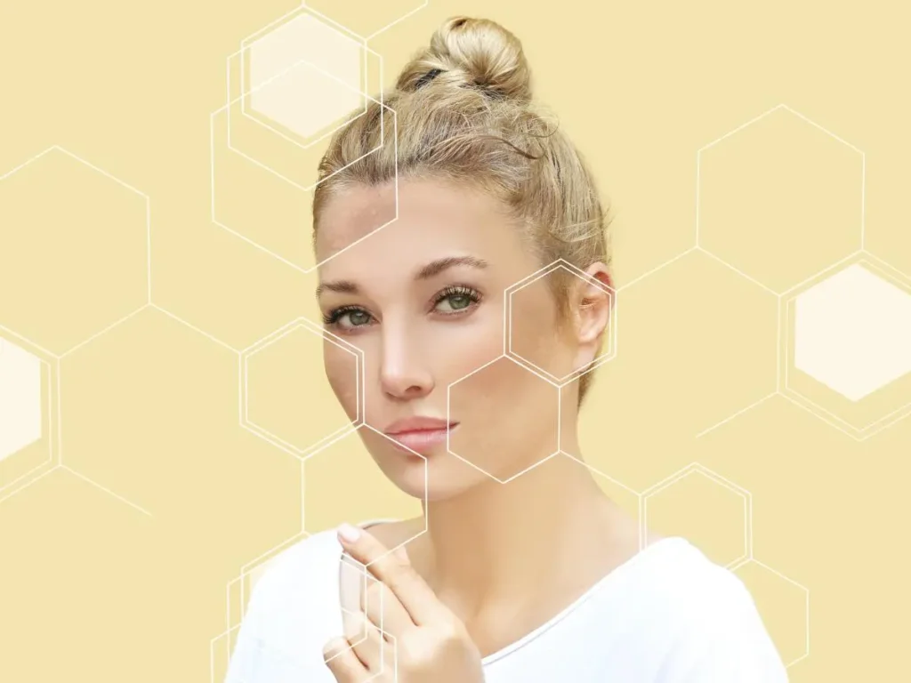 What is melasma & how does it affect skin