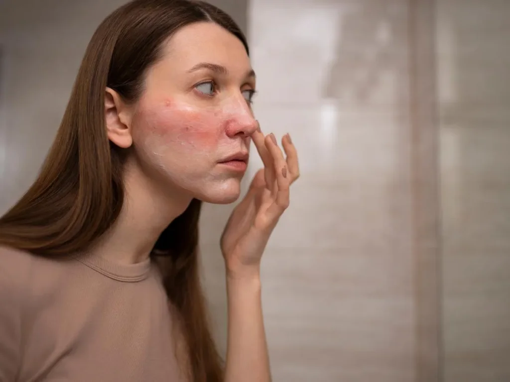 What is rosacea & how does it affect skin?