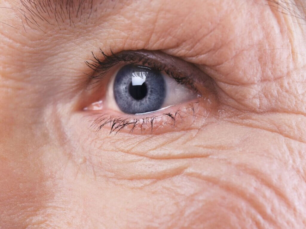 Wrinkle Symptoms