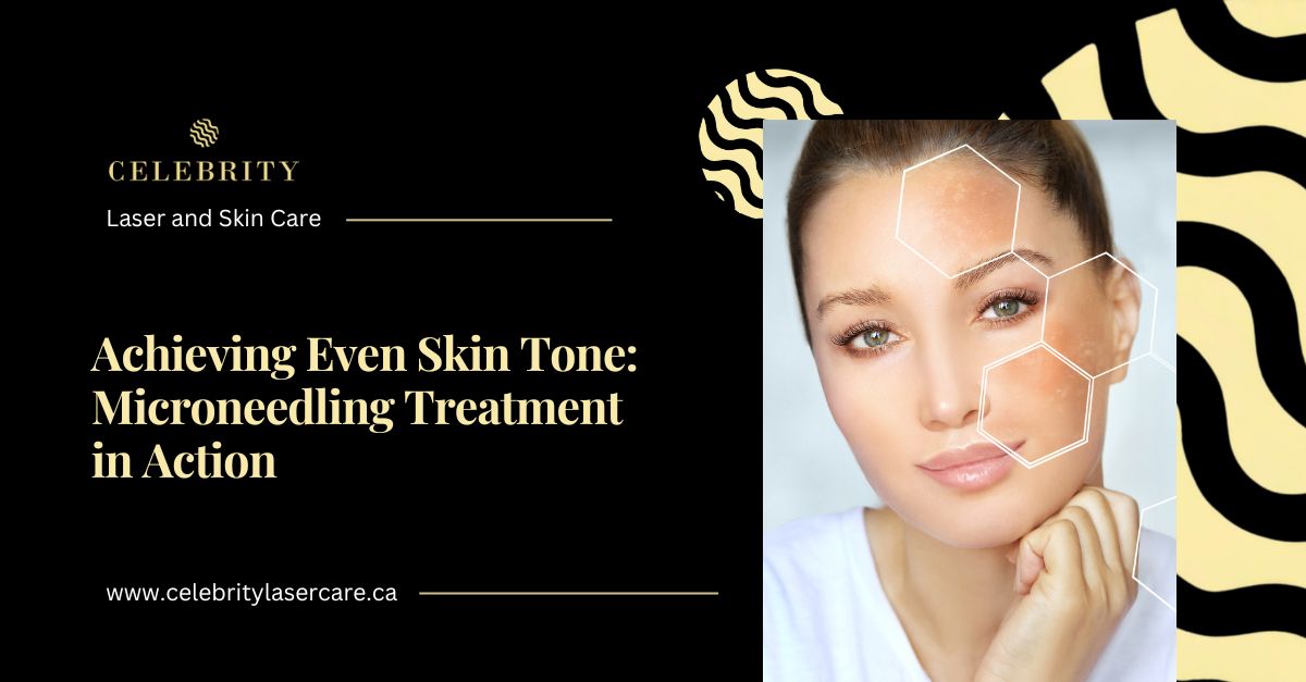 Microneedling for Hyperpigmentation